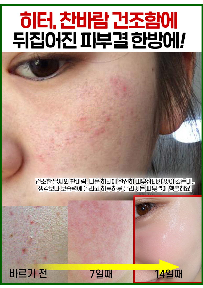 메디필 피토시카재생 비립종 3000샷
