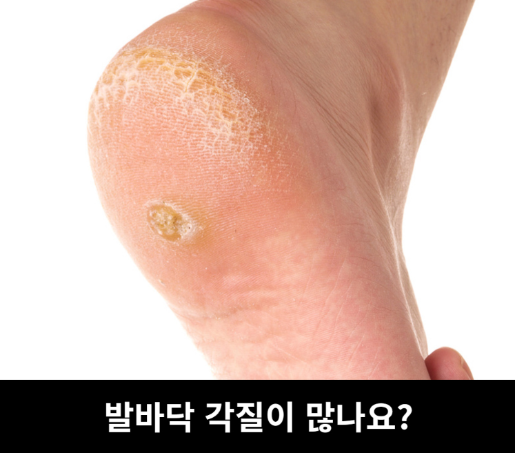 상품코드 : H3922 [아케이] 리빙 안티폴루 풋브러쉬