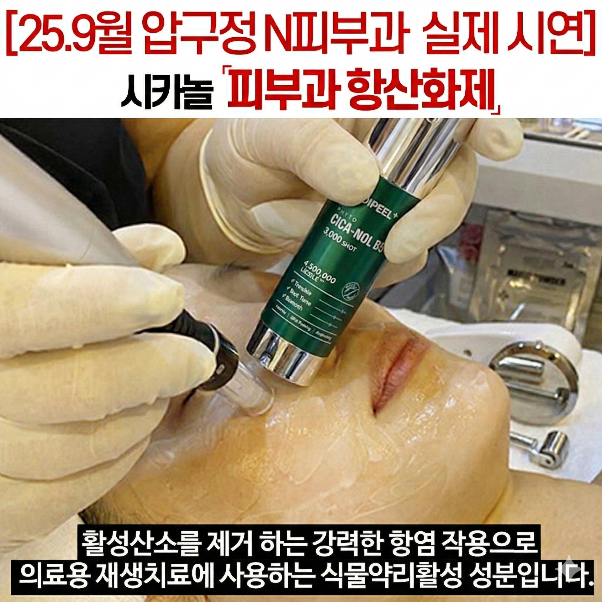메디필 피토시카재생 비립종 3000샷
