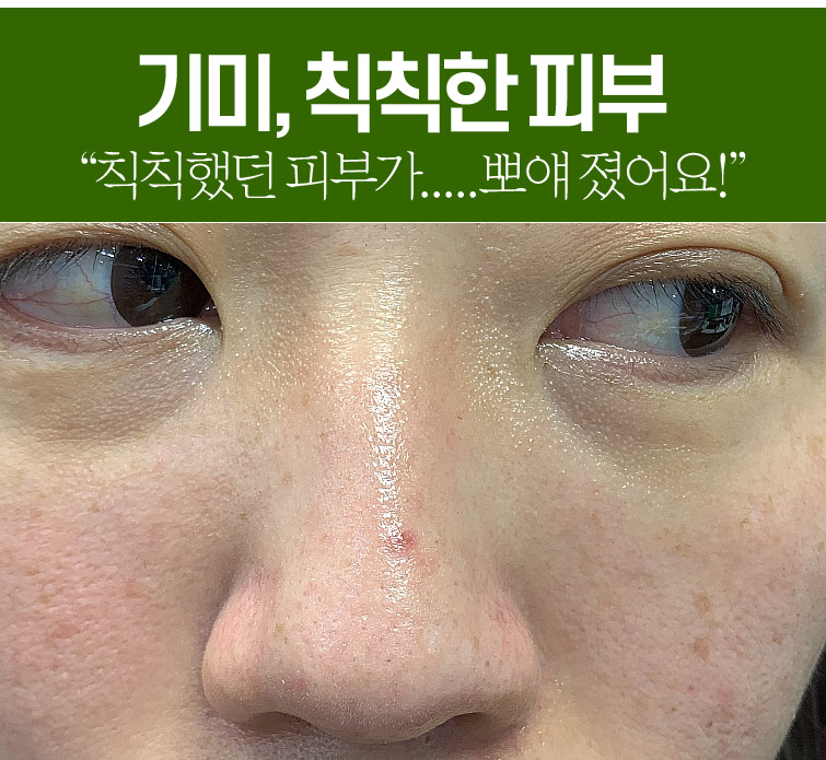 메디필 알고톡스 필오프마스크팩