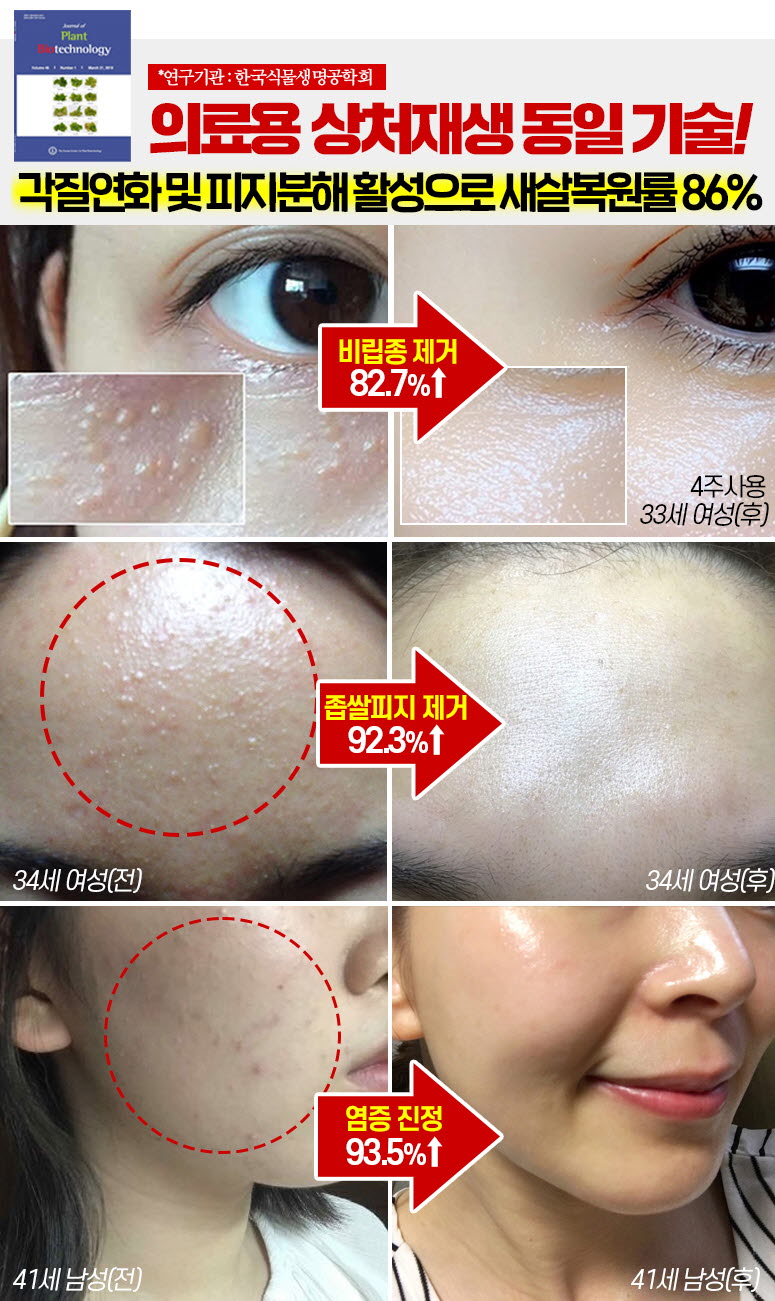 메디필 피토시카재생 비립종 3000샷