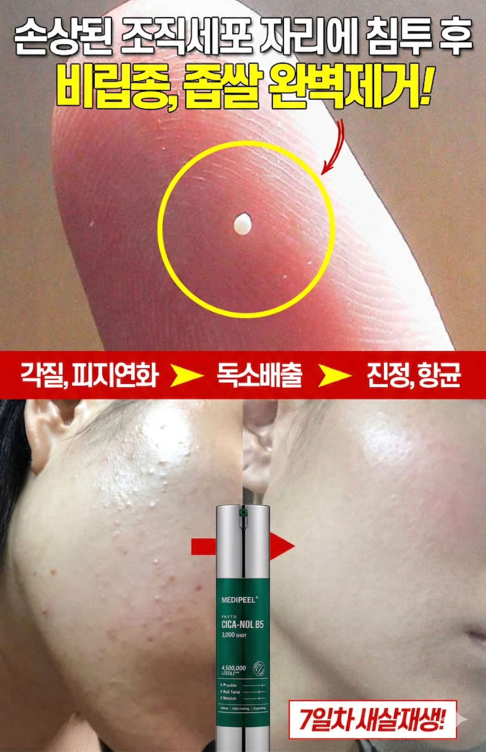 메디필 피토시카재생 비립종 3000샷