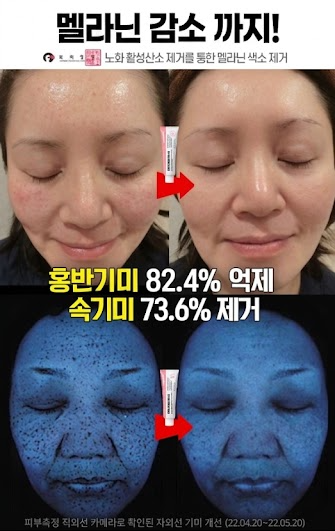 메디필 기미 멜라논엑스크림