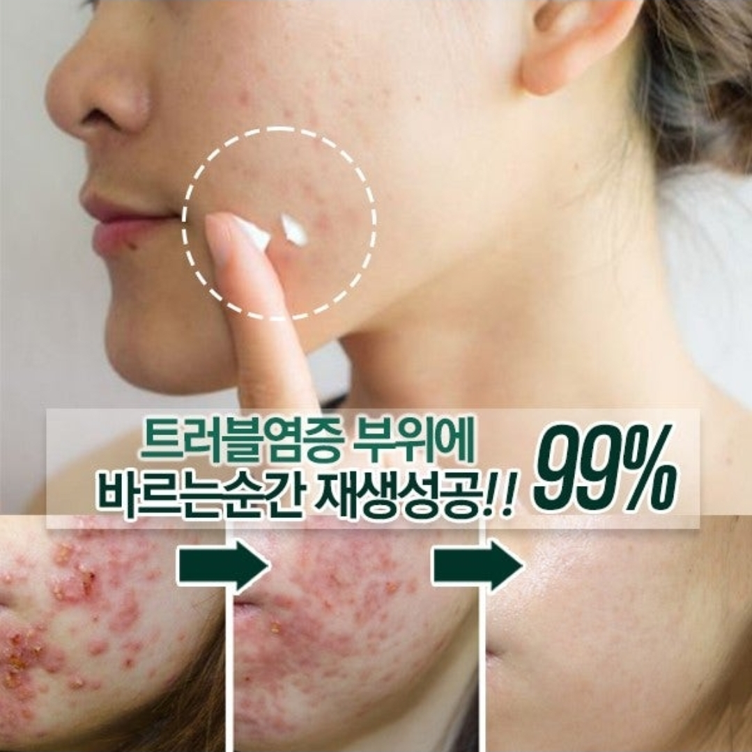 까레넬 새살솔솔 염증시카크림 용량업 40ml