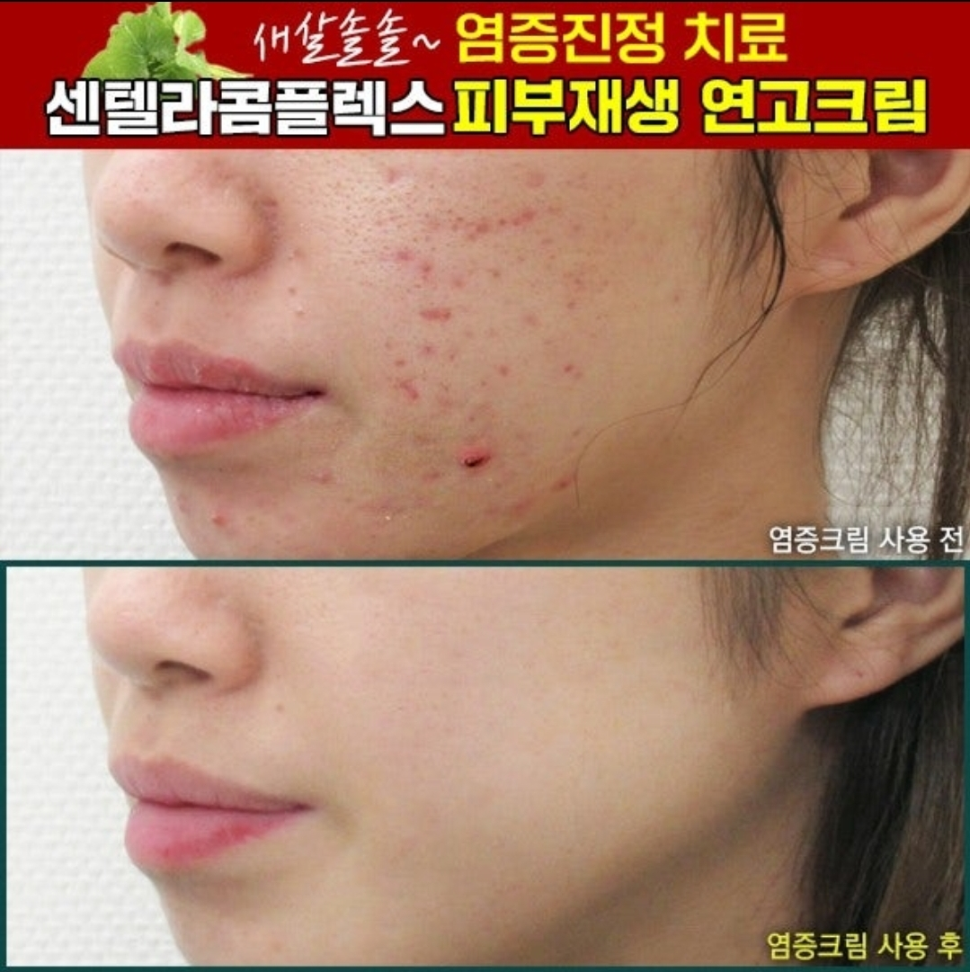 까레넬 새살솔솔 염증시카크림 용량업 40ml