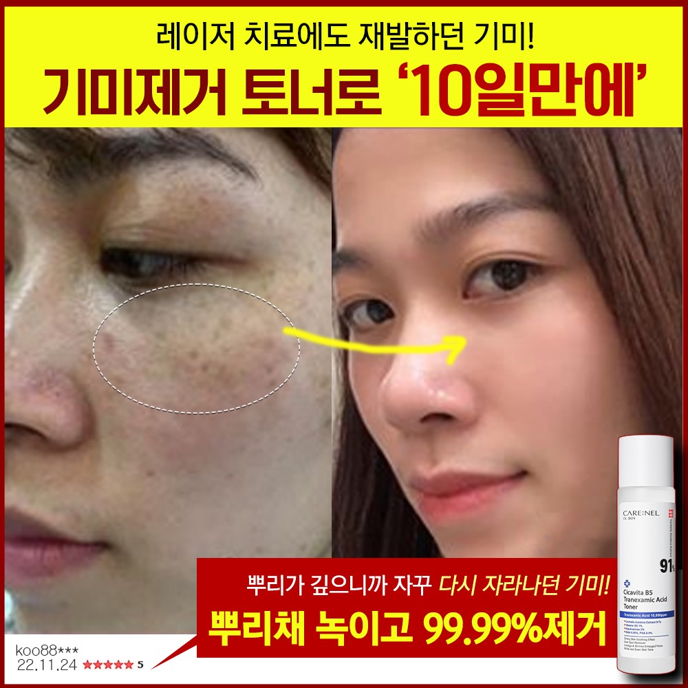 잡티스케일링 기미제거 91% 엑기스토너 155ml