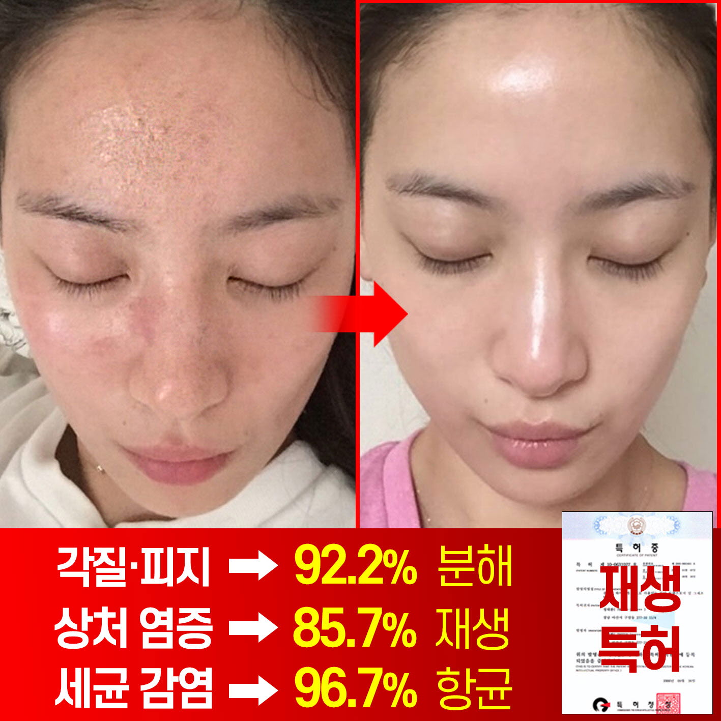 메디필 피토시카재생 비립종 3000샷