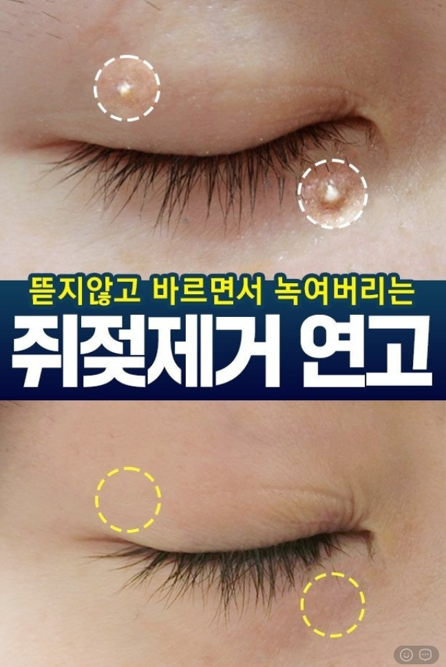상품코드 : DD004 담다다담 쥐젖 크림 더마클리어스팟크림_20ml (카톤발주용)