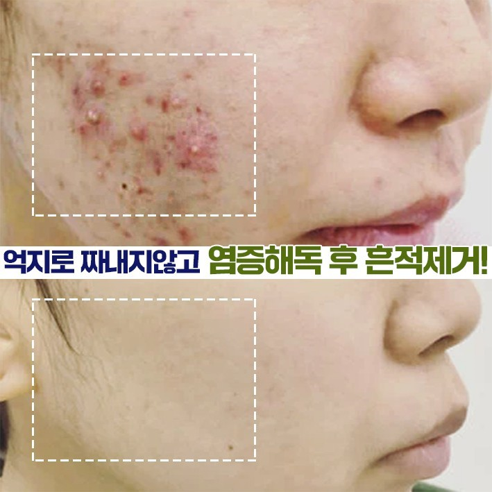 까레넬 히아루 비타5 시카세럼 30ml