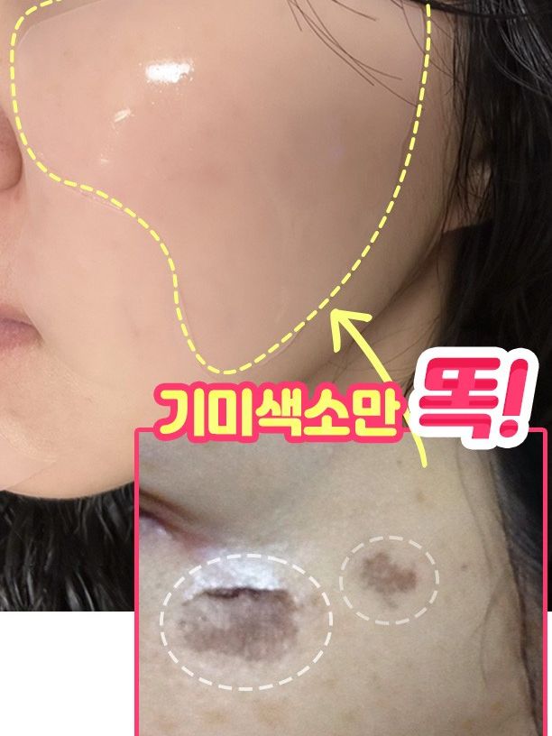 기미색소떼어내는! 대용량 멜라토닝 기미패치